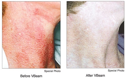 Vbeam Laser Technology now available at Gwinnett Dermatology!