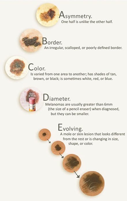 characteristics of melanoma